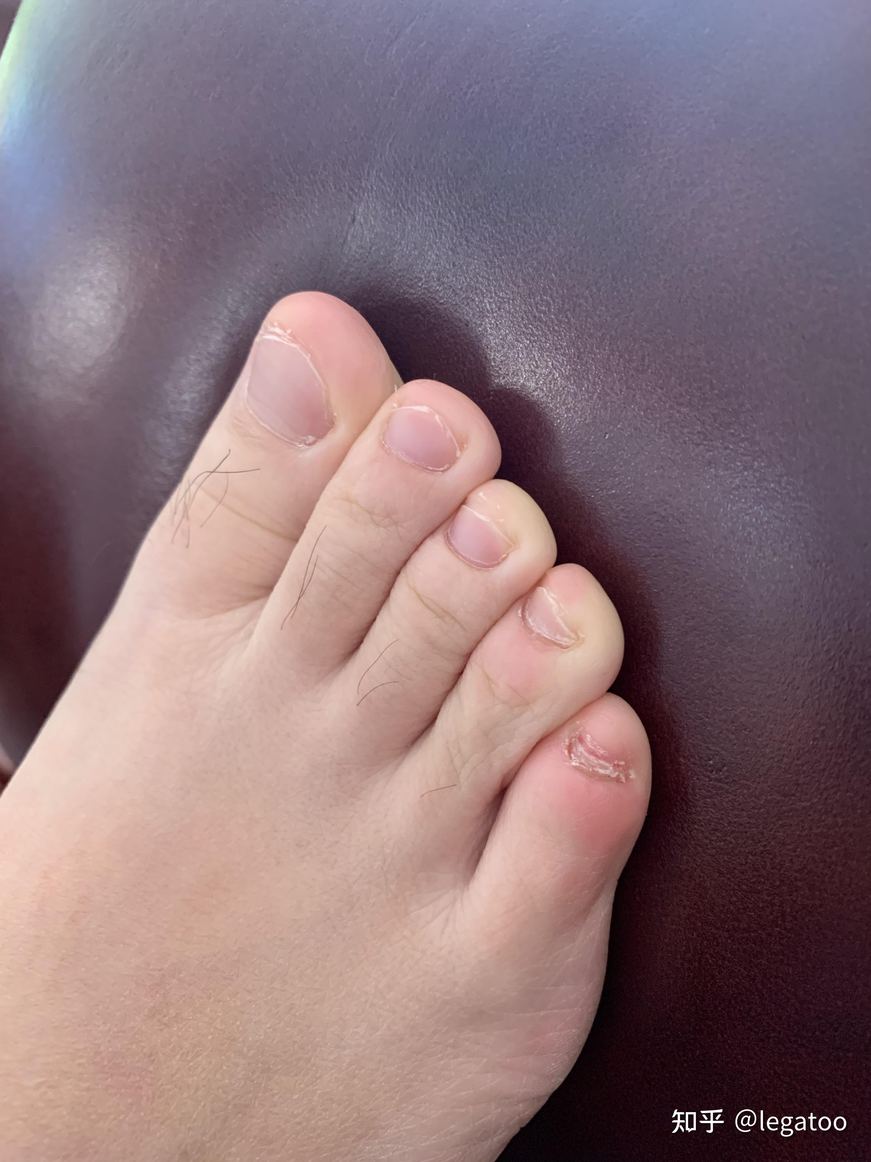 小脚趾没有脚指甲盖,只有一个类指甲的丁? - 知乎