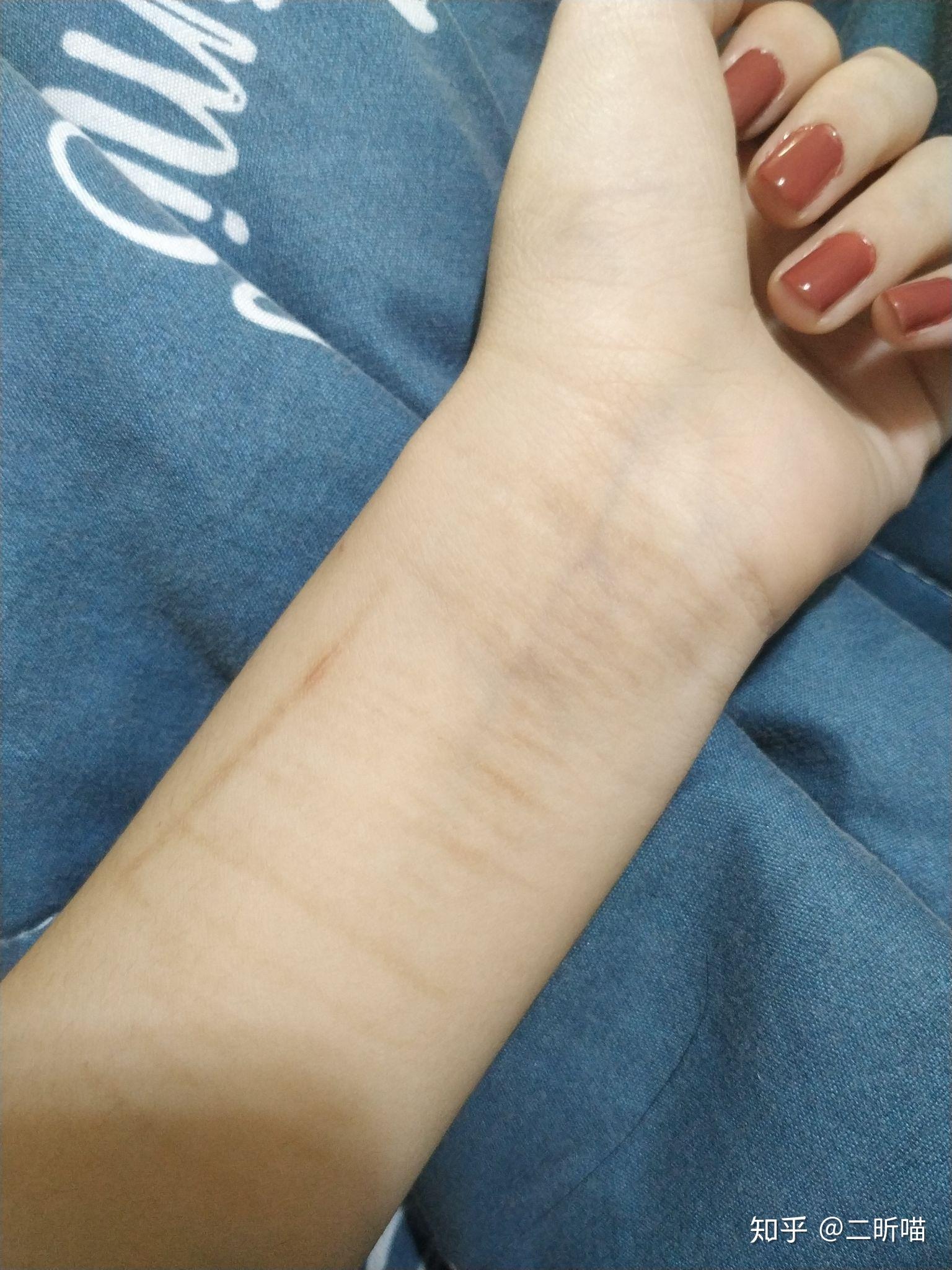 割腕的疤可以去掉吗? - 知乎