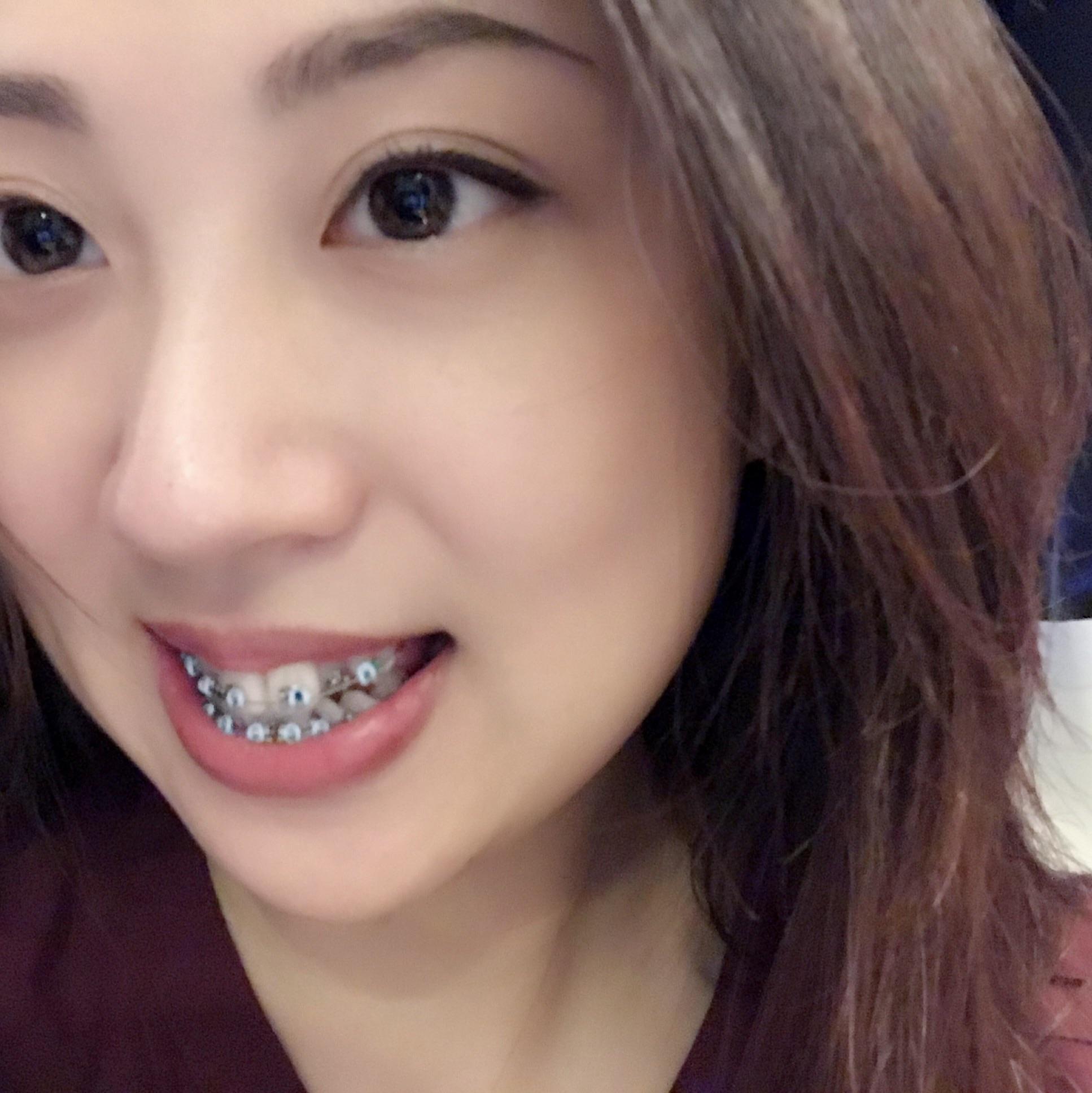 25岁开始箍牙是什么体验大钢牙也可以美美的