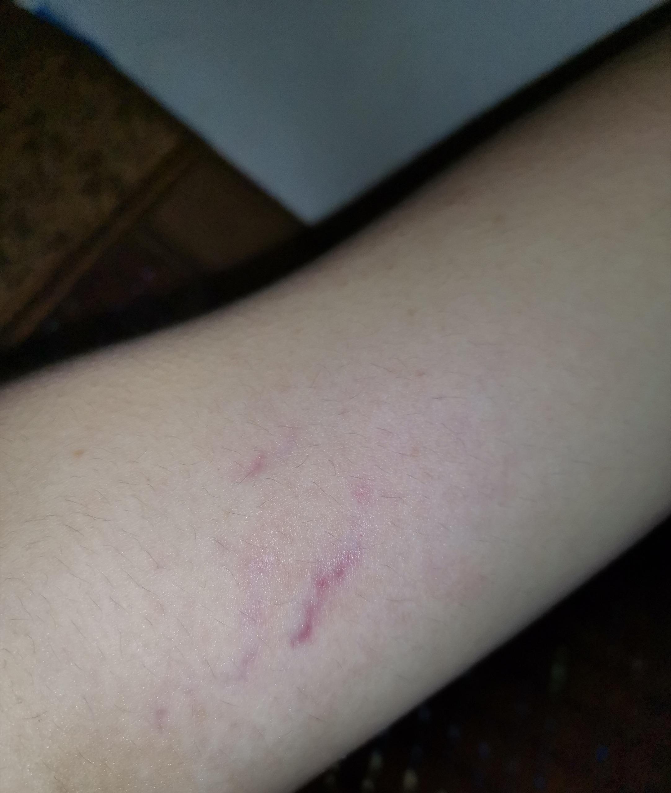 接近胳肢窝的后手臂内侧有紫青色脉络状的东西是什么病