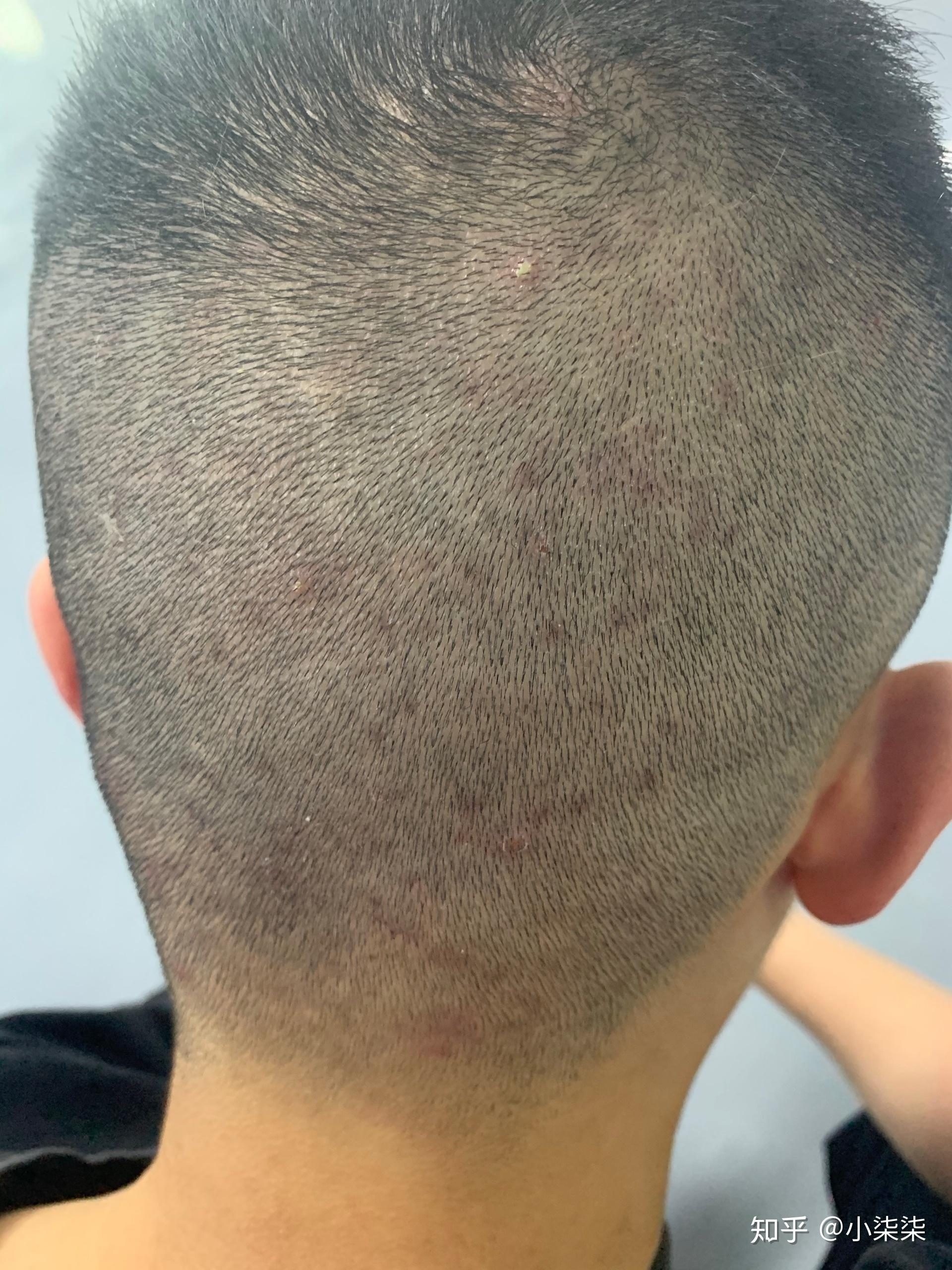 头皮上有很多红色连片的疙瘩 怎么办? - 知乎