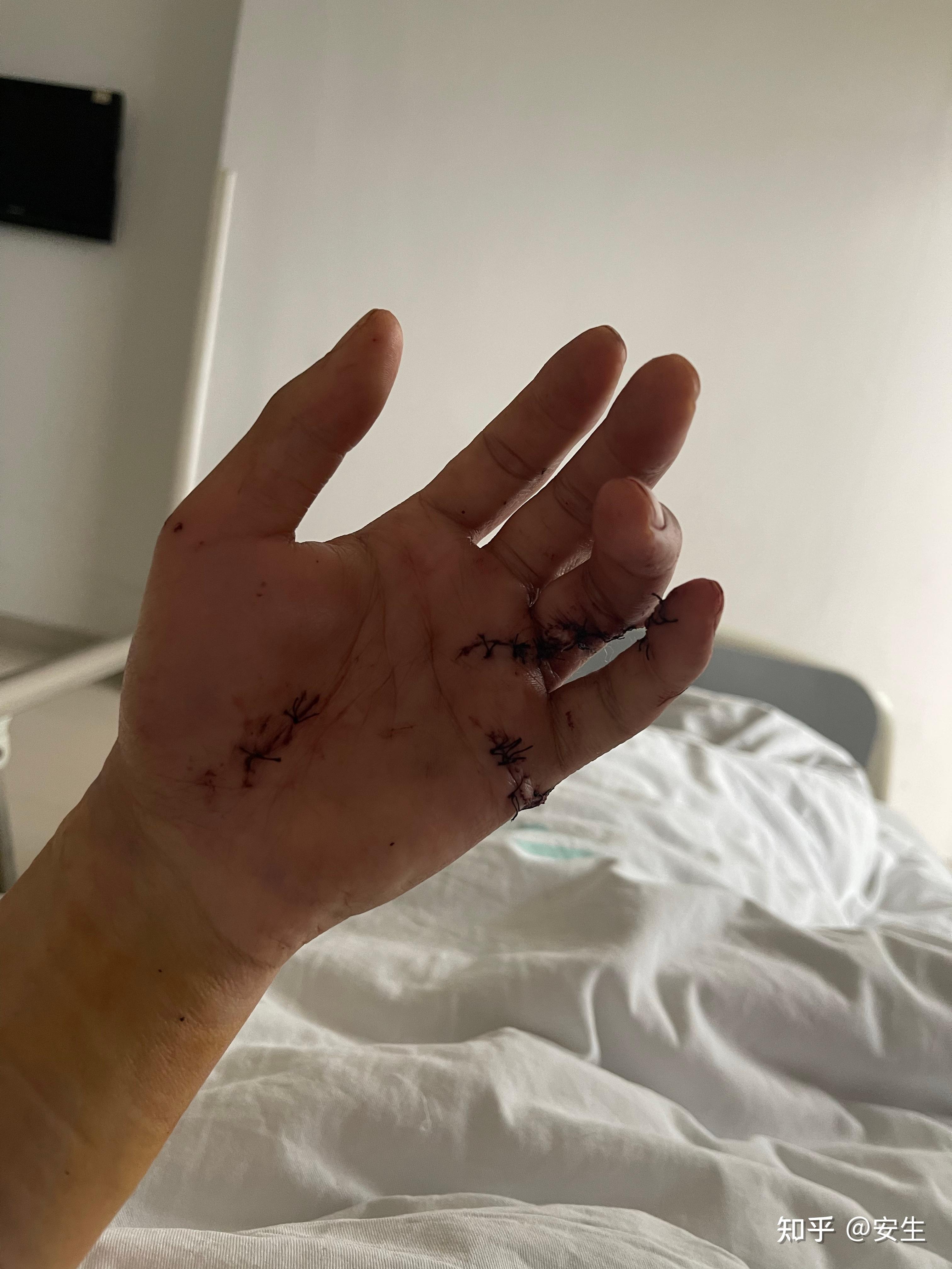手指肌腱断裂有解无解?