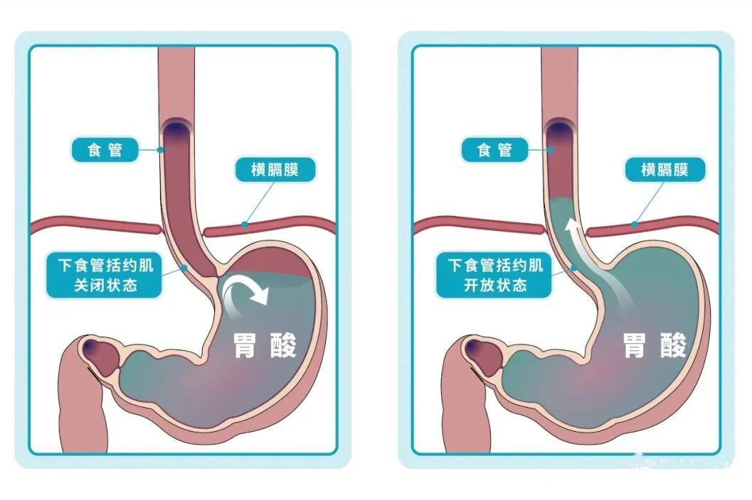 9种在家治疗胃酸反流的方法！最后一招见效快 - 知乎