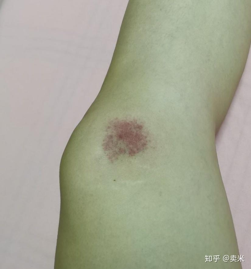 被蚊子叮咬之后肿得很严重一个星期左右才会消肿变成紫红色淤血癍块