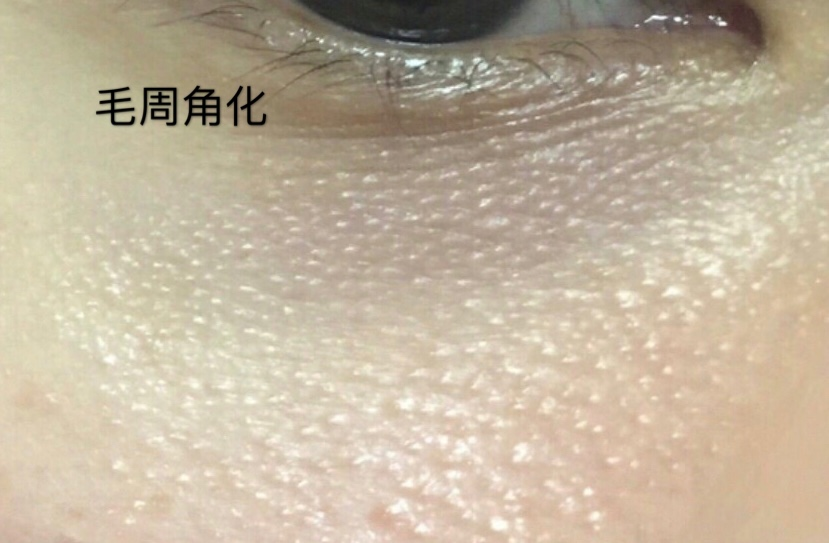 眼下很多这种白色小粒粒,感觉不像脂肪粒,请问到底是什么? - 知乎