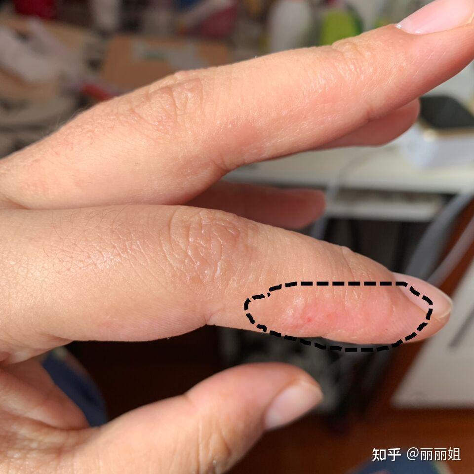 汗疱疹水泡呈蜂窝状?