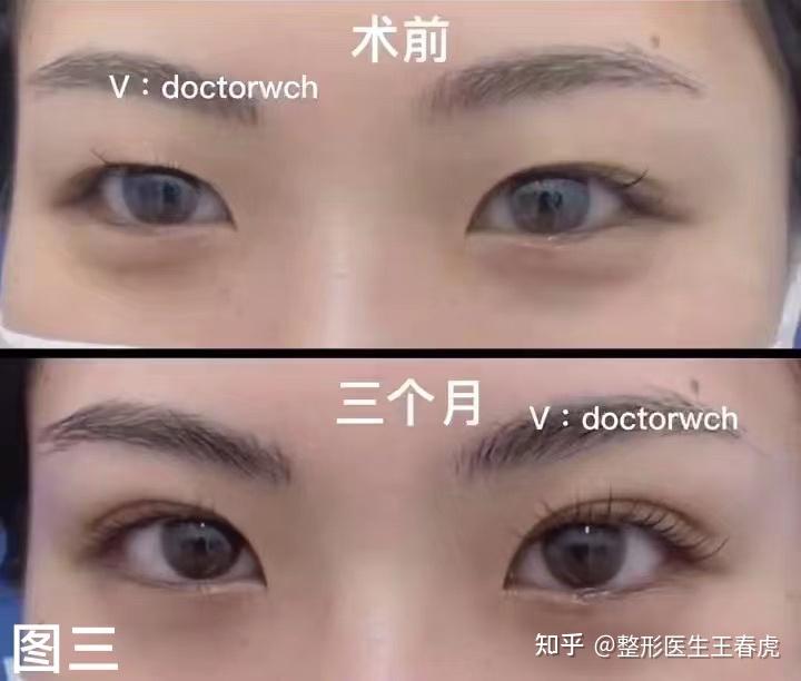 内双可不可以做双眼皮呢? - 知乎