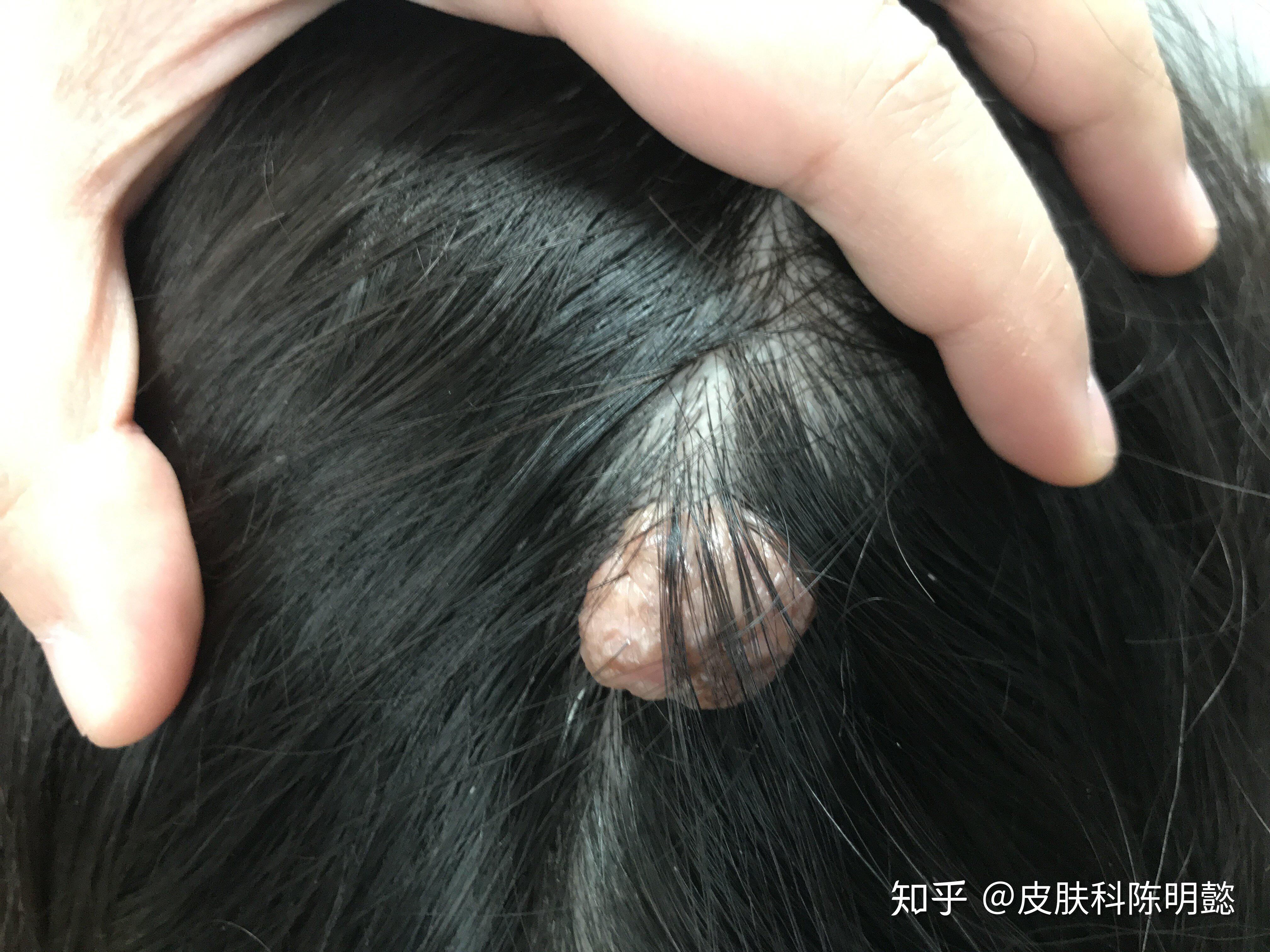 头上的痣能祛吗? - 知乎