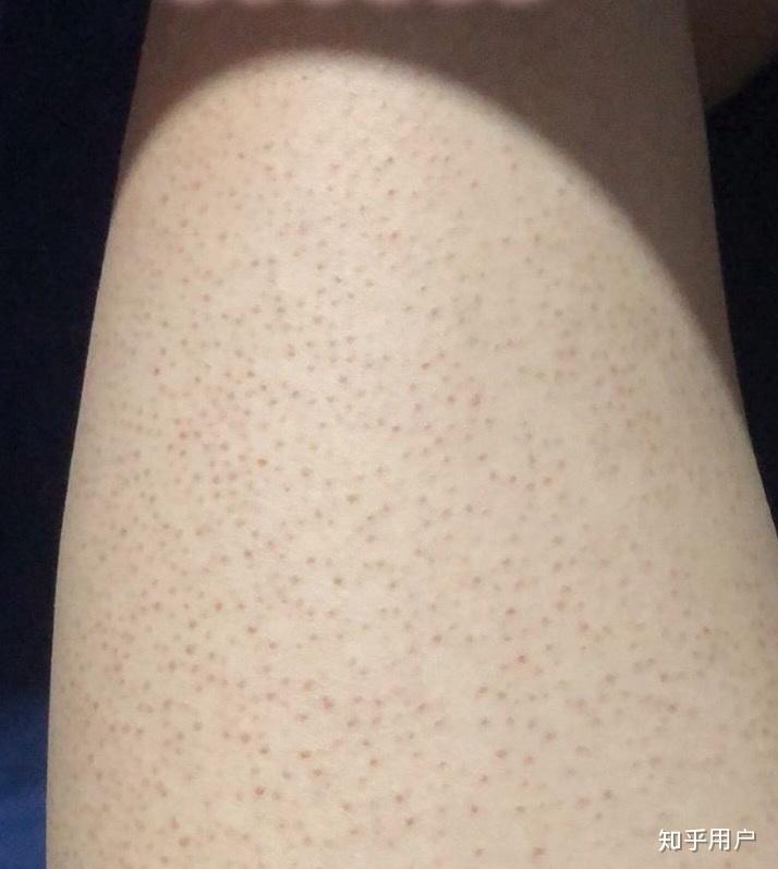 腿鸡皮肤难看(大腿为什么会有鸡皮肤) 腿鸡皮肤难看(大腿为什么会有鸡皮肤)