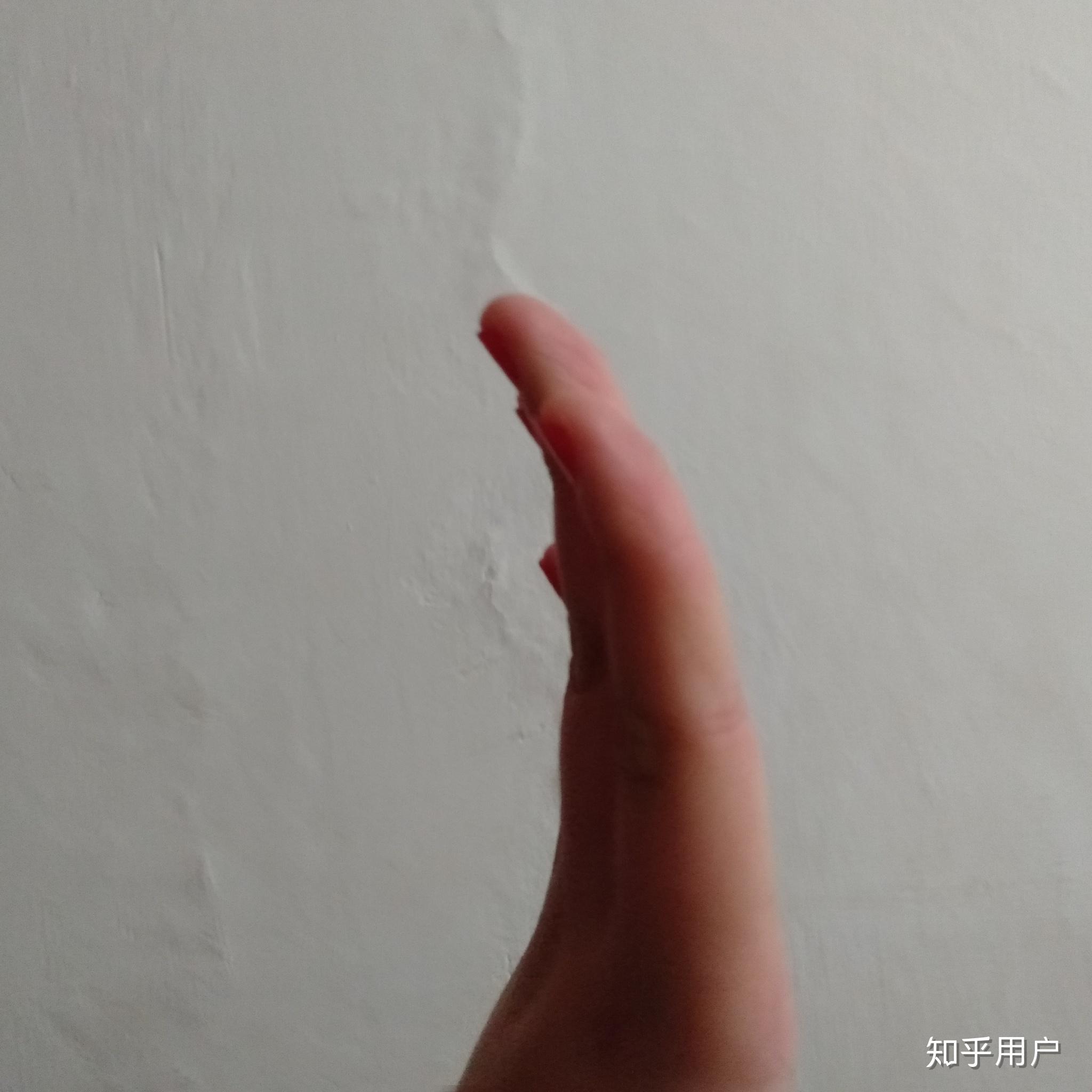 手指伸直后手指的第一个指节向上翘起这是因为什么原因?