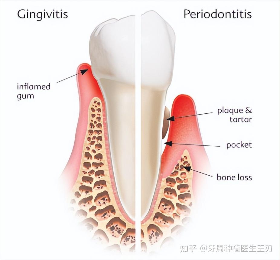 如何治疗牙周根分歧病变 - 知乎
