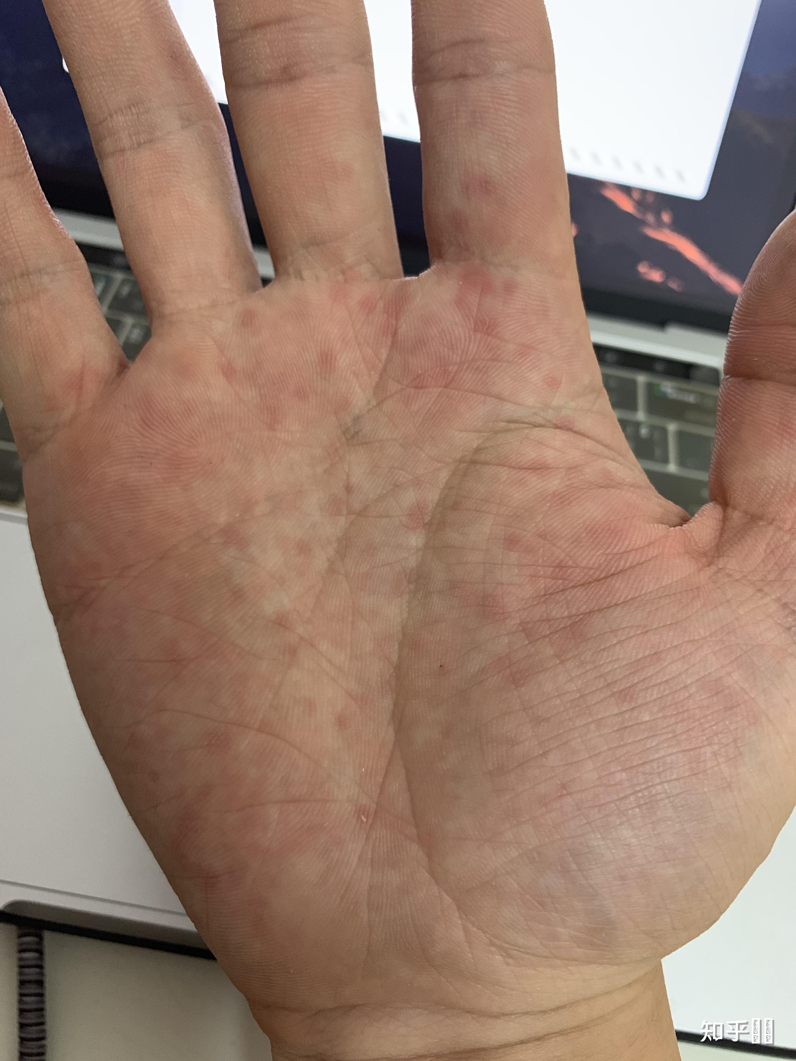 一到春秋两季,双手手心就会出现红点,很疼,略痒.