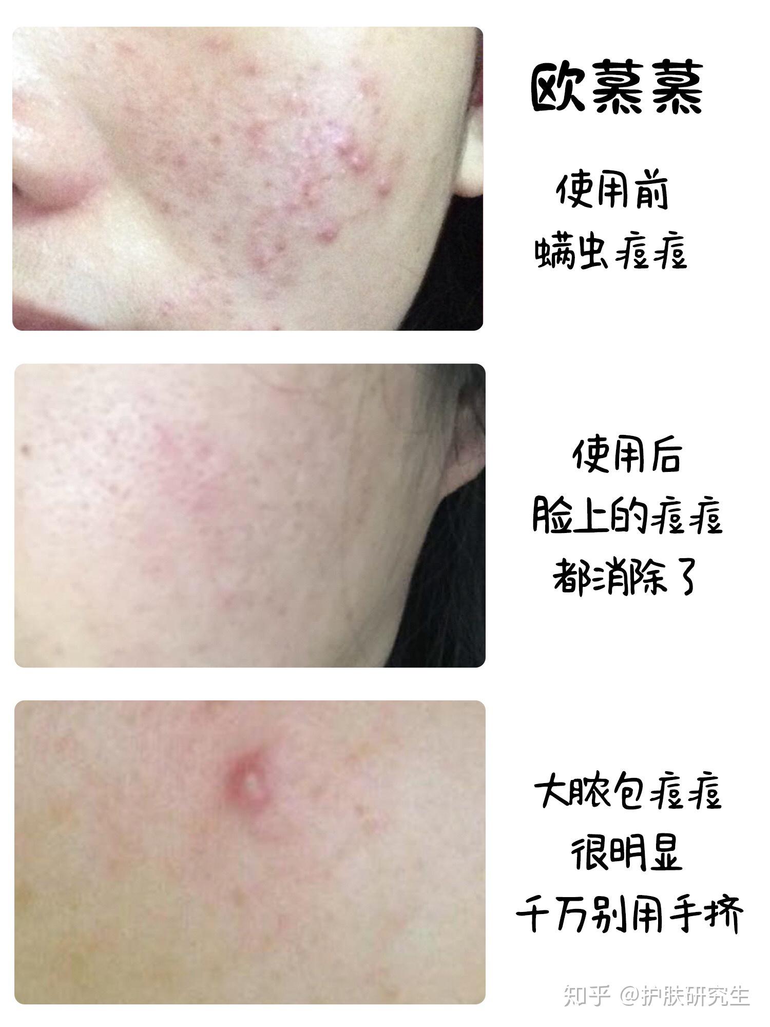 请问怎么才能判断痘痘是不是因为螨虫引起的?认真求问啊……? - 知乎