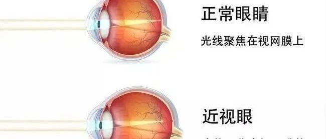 近视、远视、散光，都是因为这个原因！ - 知乎