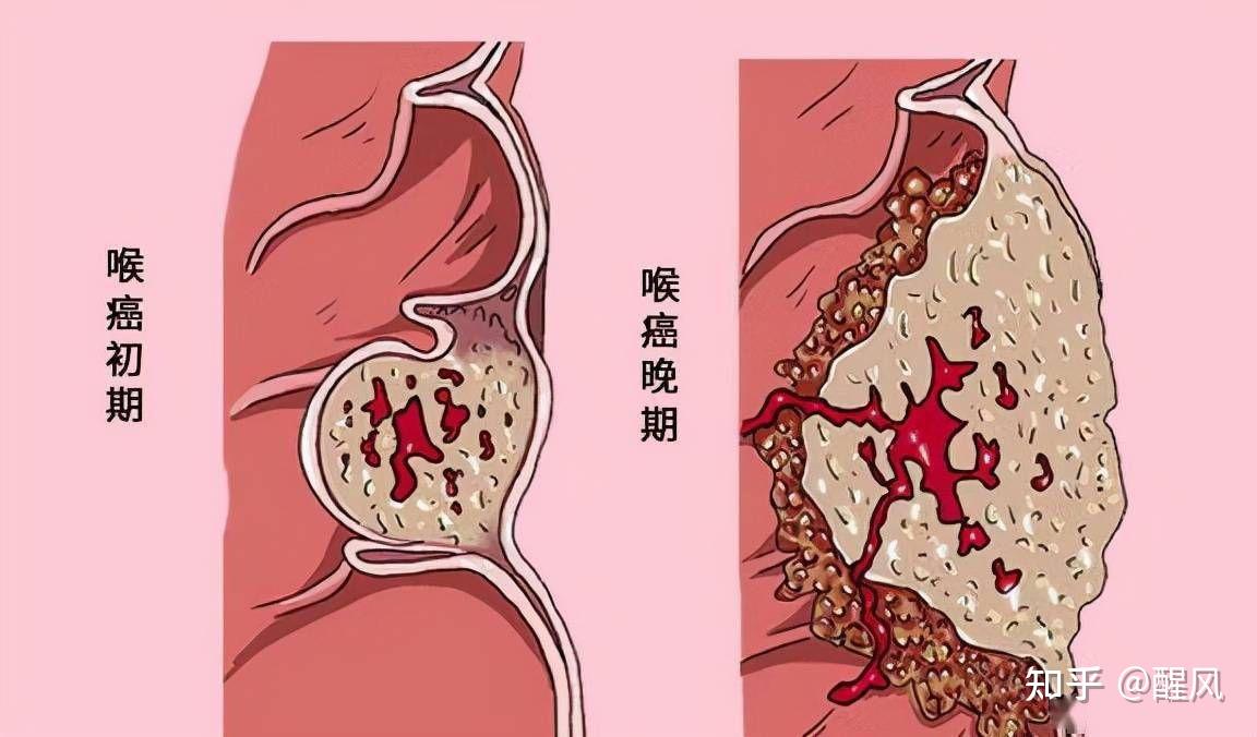 喉癌有什么具体表现? - 知乎