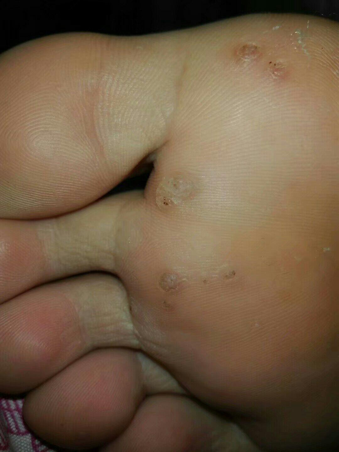 脚趾疣初期图片图片