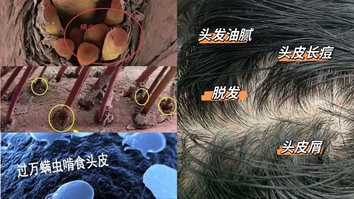 头皮油、头皮屑、头皮痒…疯狂掉头发的背后竟是因为它们??皮肤科医生的方法,直接养好折磨我3年的头皮问题,再也不掉头发! - 知乎