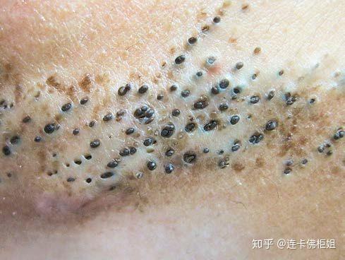 请问有什么适合学生党缓解黑头的办法