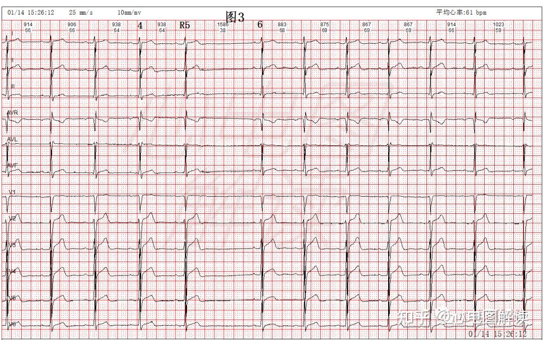 心脏漏搏的心电图图片