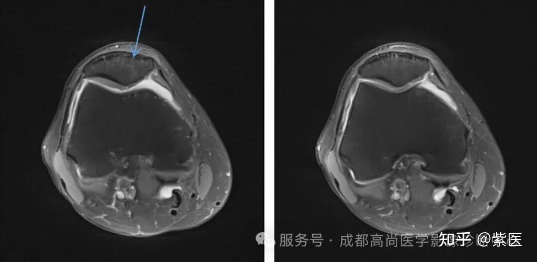 膝关节滑膜皱襞综合征(MPS)MR诊断 - 知乎