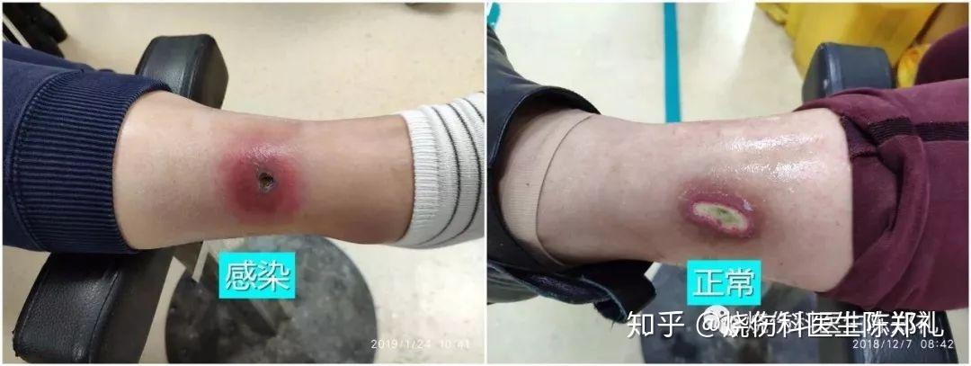伤口本来已经好转了,为什么突然又痛了? - 知乎