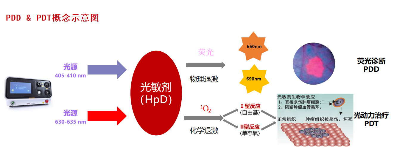 肿瘤光动力疗法(Photodynamic therapy,PDT) - 知乎