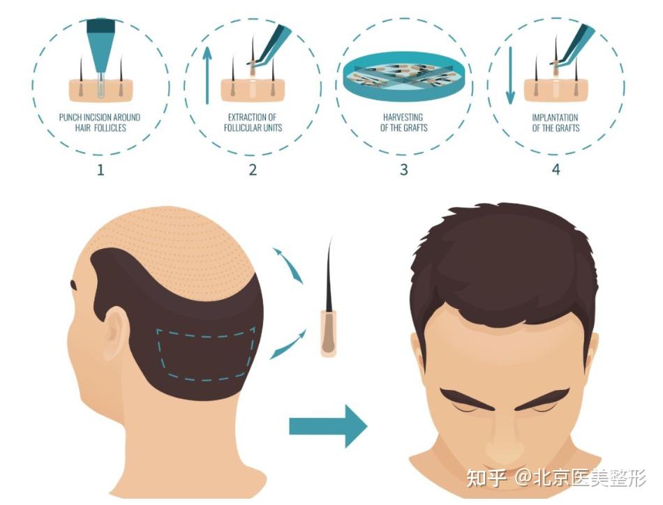 北京米兰柏羽丽都不剃发植发和剃发植发区别有哪些 - 知乎