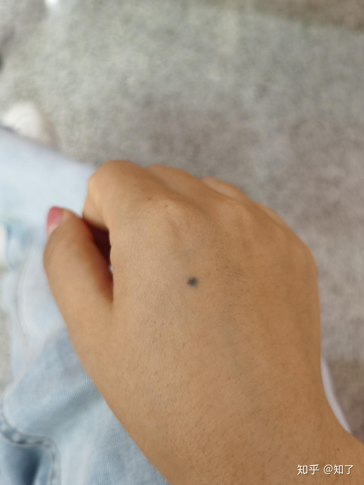 手上长了颗蓝色的痣我好方请懂的人帮我看一下好不好有问题