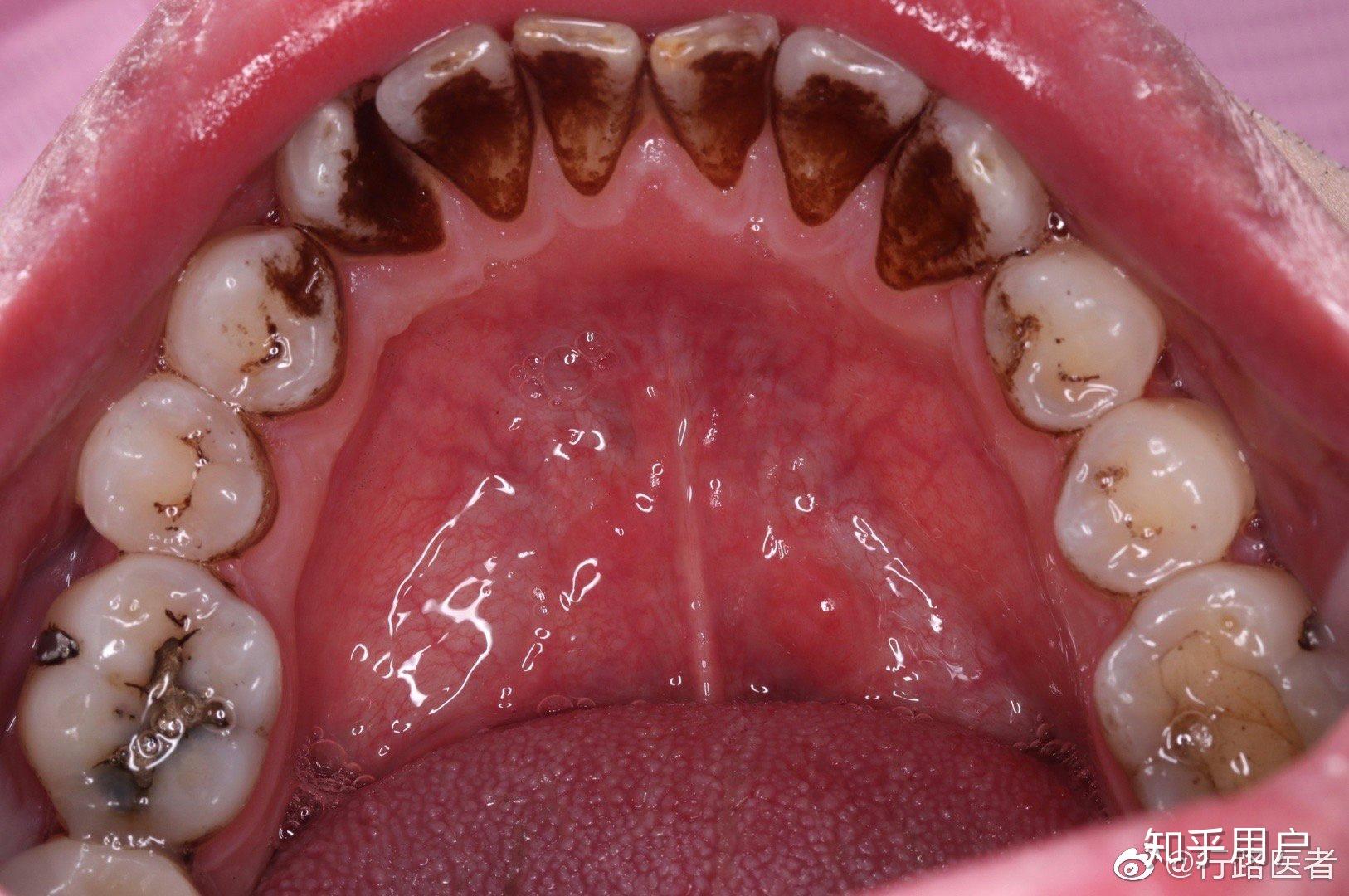 去洗牙牙结石严重会不会很尴尬