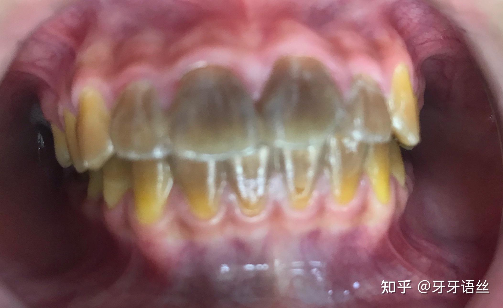 冷光牙齿对比照片(四环素牙)-赵振的博客-KQ88口腔博客