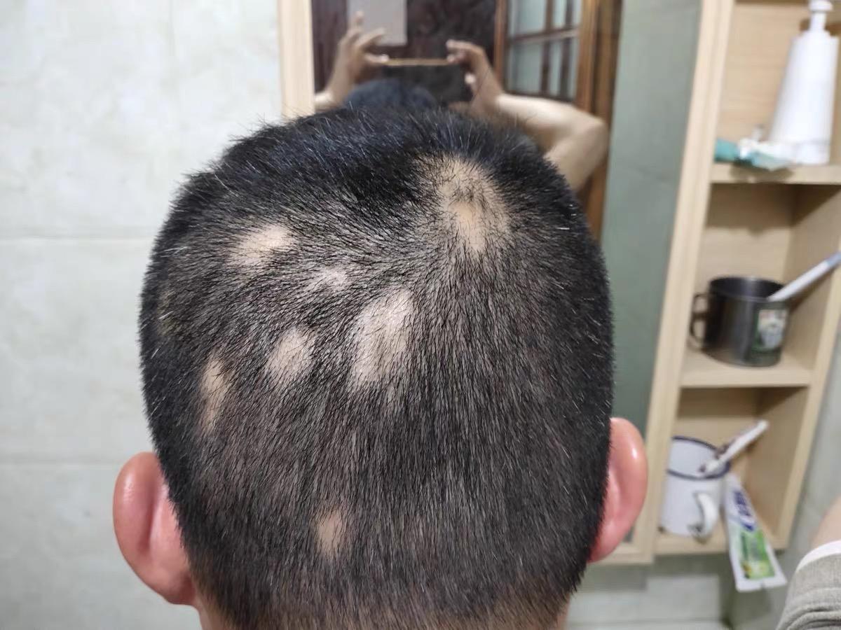 斑秃有哪些表现致病原因是什么该如何预防和治疗呢