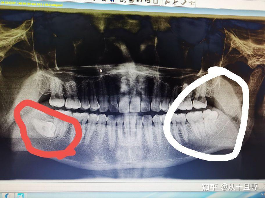 长了四颗智齿下面两颗是全埋伏低位水平阻生不疼可以不拔吗