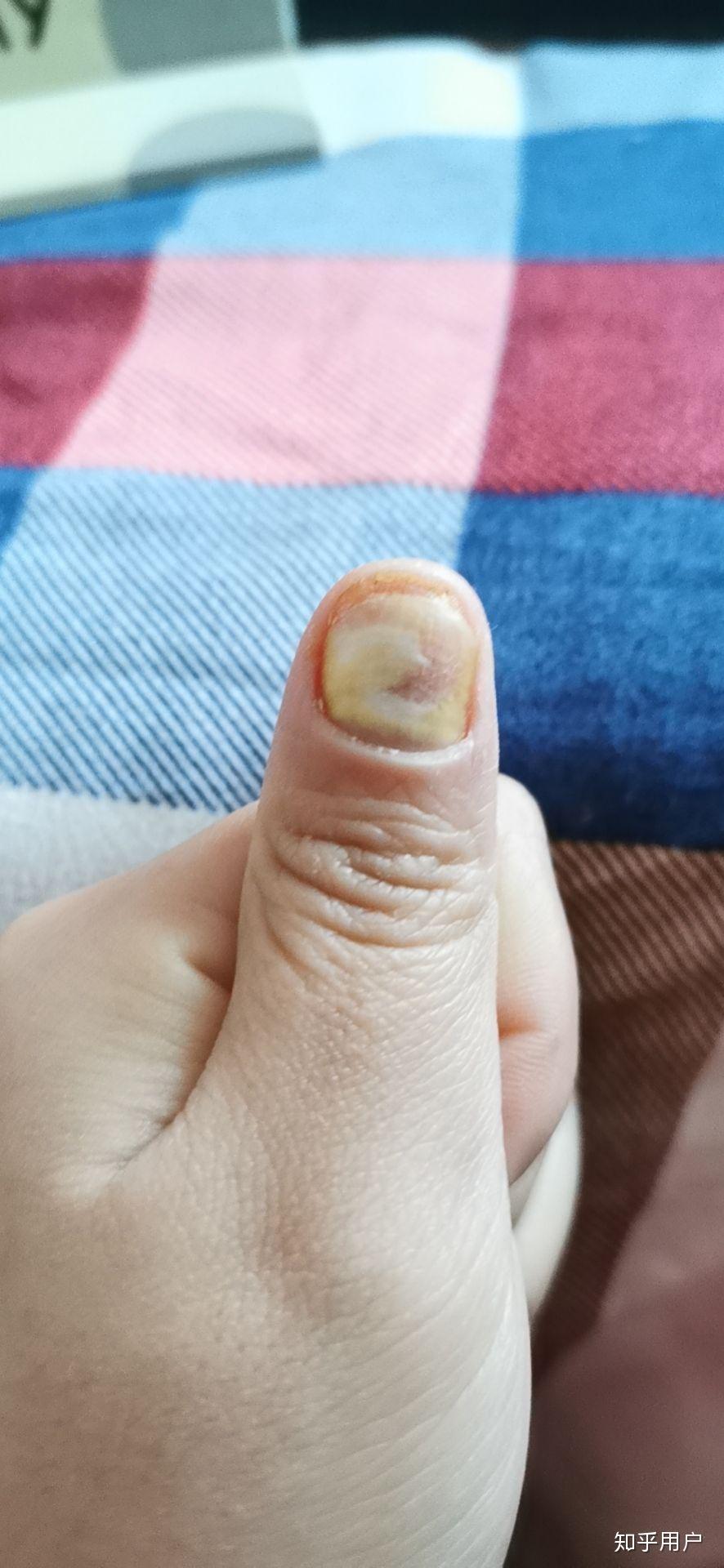 白醋泡大蒜能治疗灰指甲吗? - 知乎