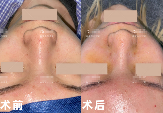 鼻骨内推手术能达到什么效果?手术是怎样操作的?有什么风险和后遗症?