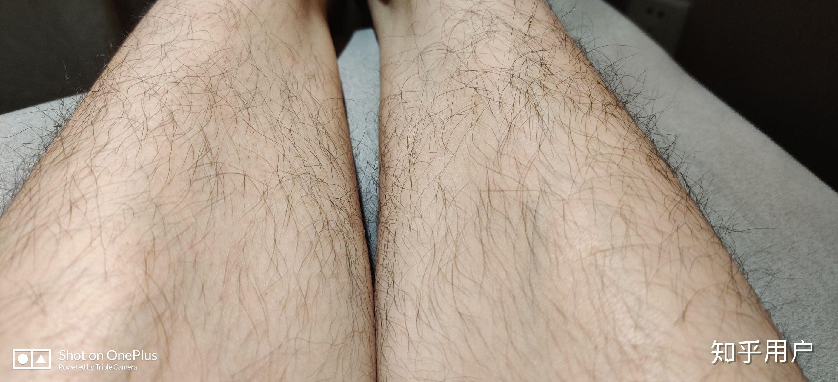 腿毛真的会越刮越多吗