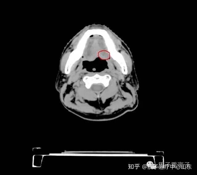 舌根癌质子治疗(本院病例分享） - 知乎