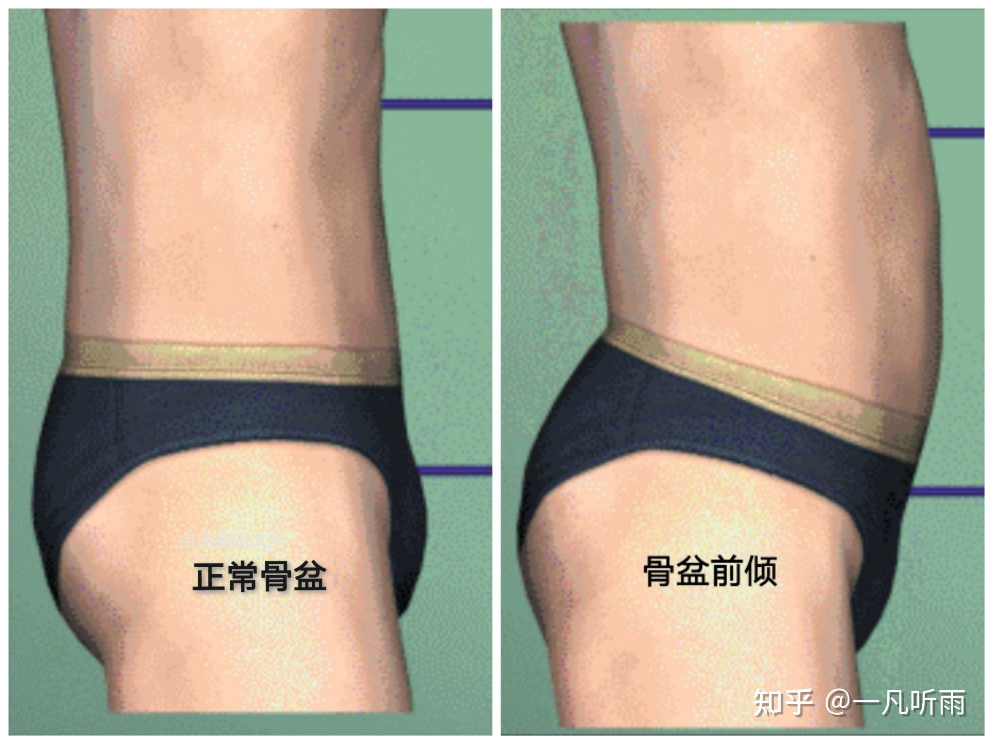 怎么判断是不是骨盆前倾? - 知乎