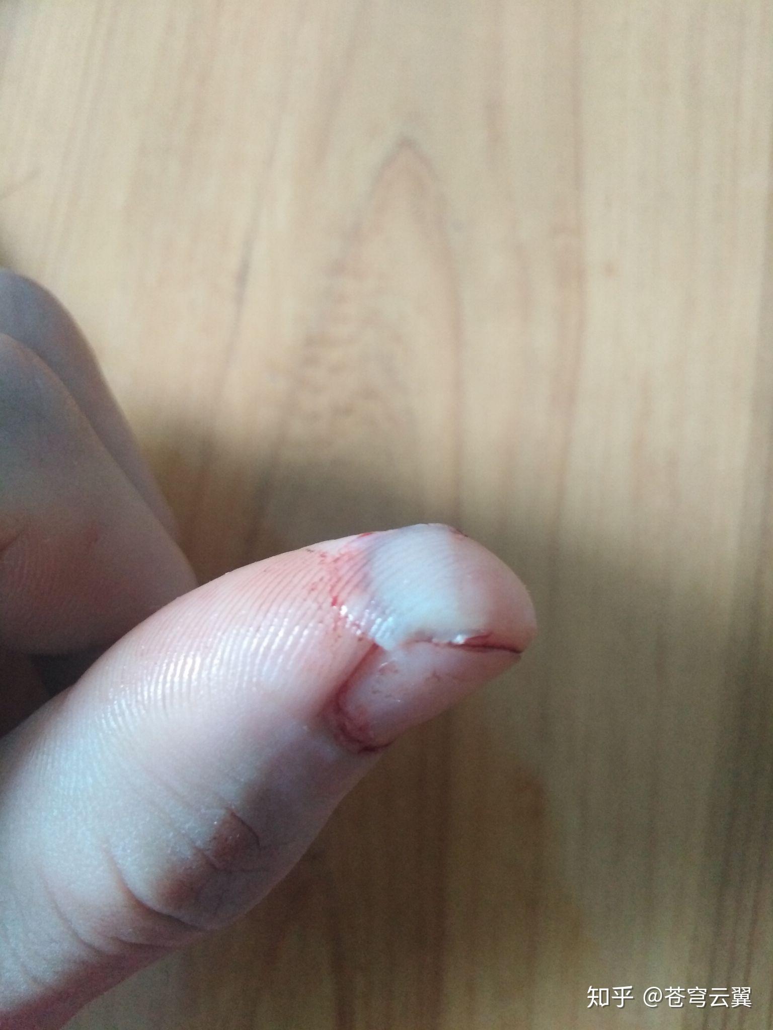 切菜时切到手是一种什么样的体验