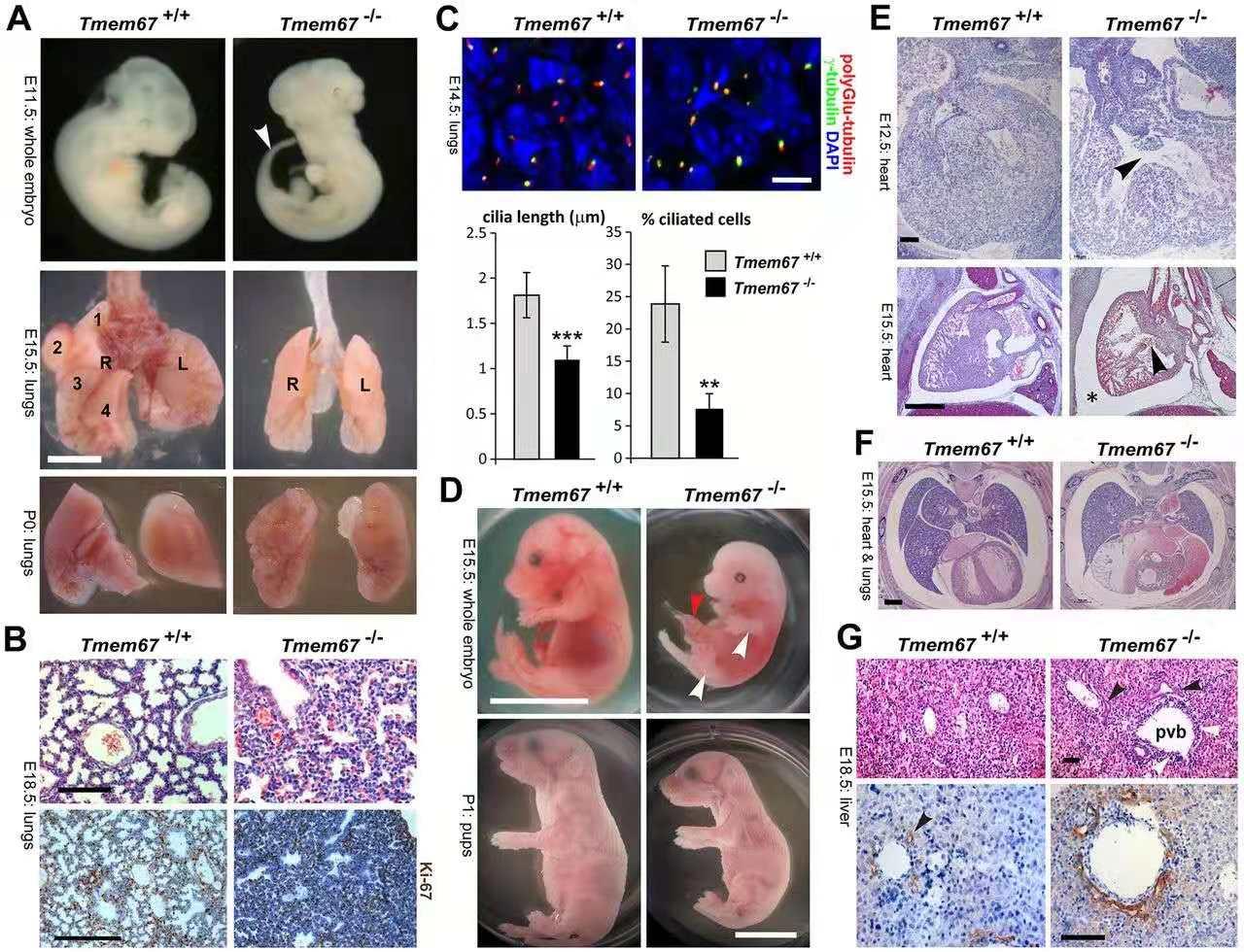 神经管畸形科普- 知乎