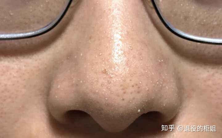 如何去脂质微丝