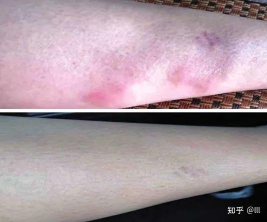 皮肤也会感染结核病 皮肤健康需关心 - 知乎