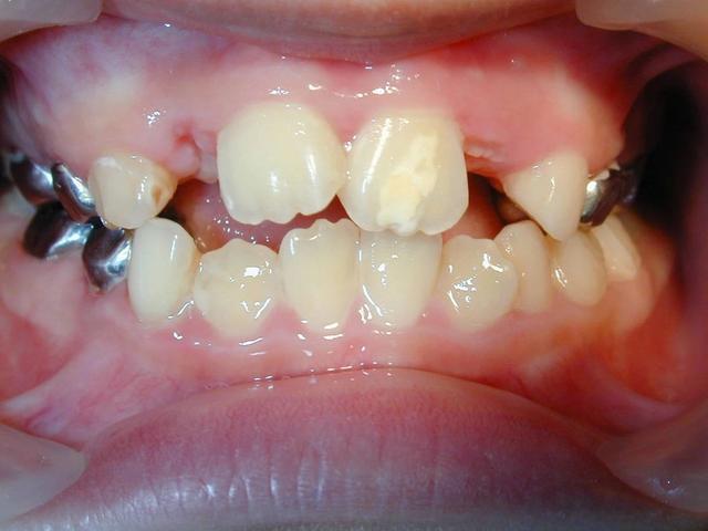 孩子换牙后牙齿出现钙化不良,补钙有用吗?