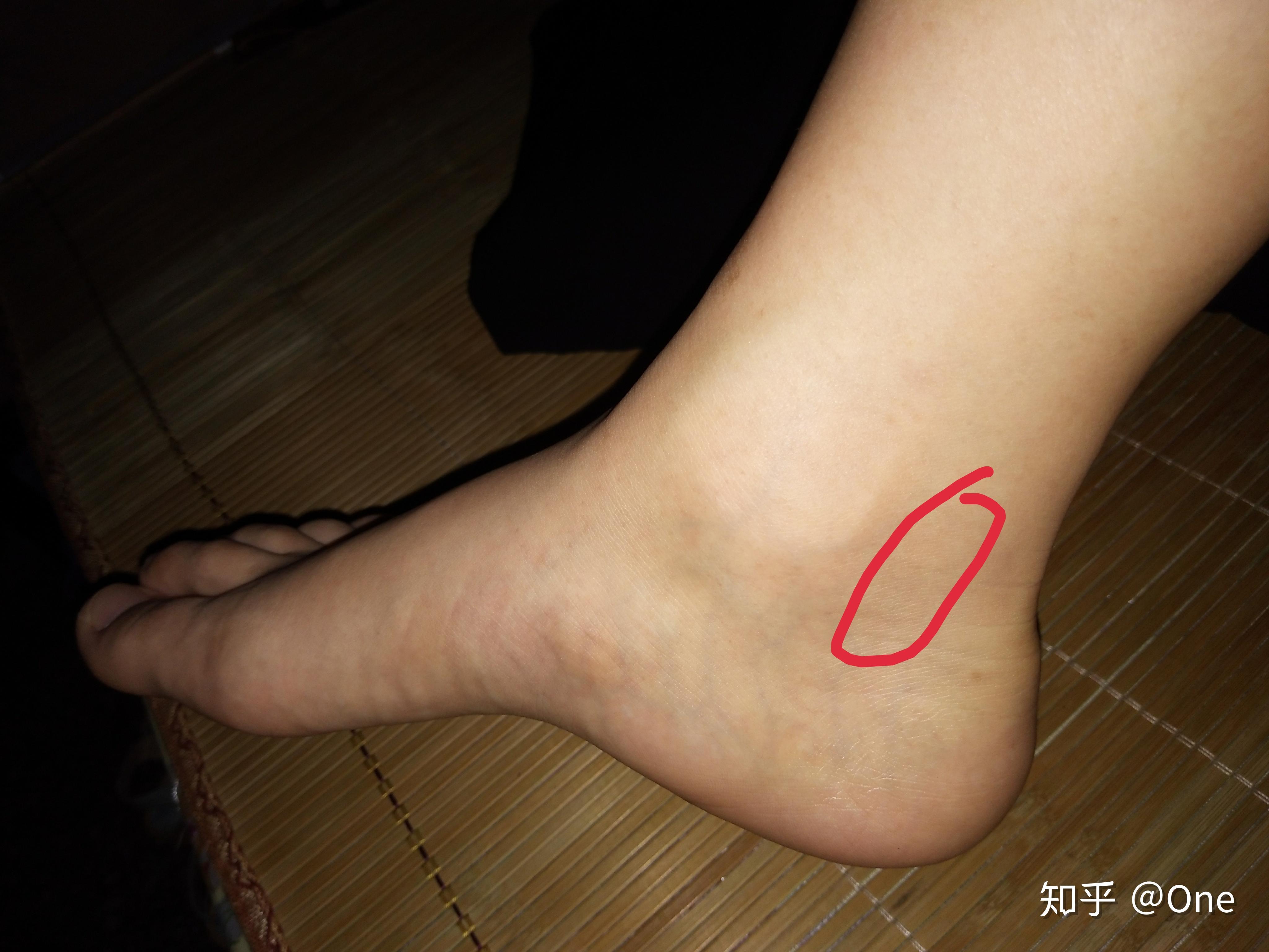 右脚踝疼? - 知乎