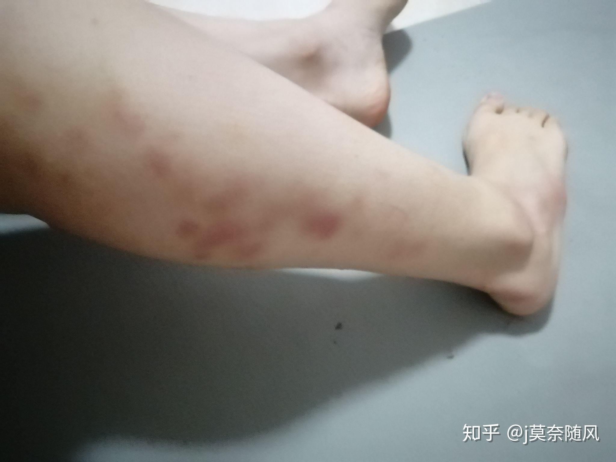 跳绳跑步腿变粗,用木质狼牙棒滚小腿有大量淤青,要停止运动吗? - 知乎