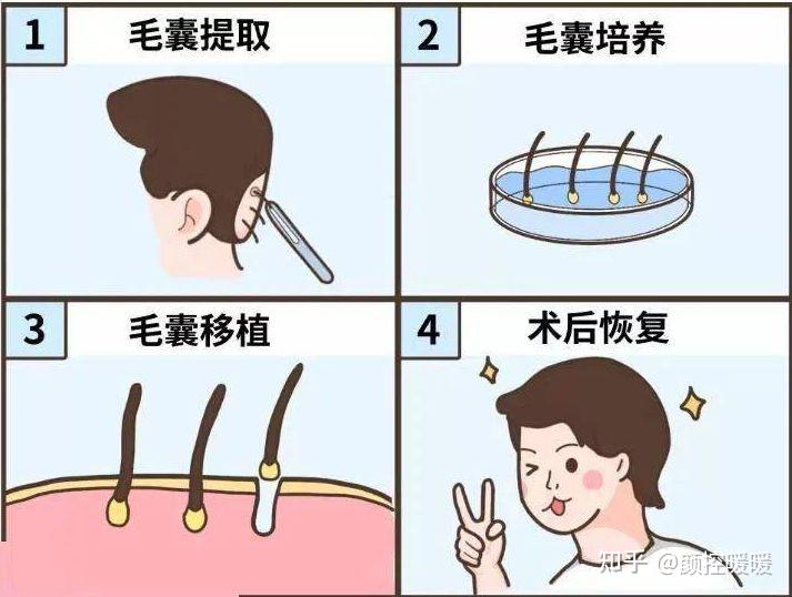 为什么植发只能维持三五年?植发后期还需要复种么?揭秘来了。 - 知乎