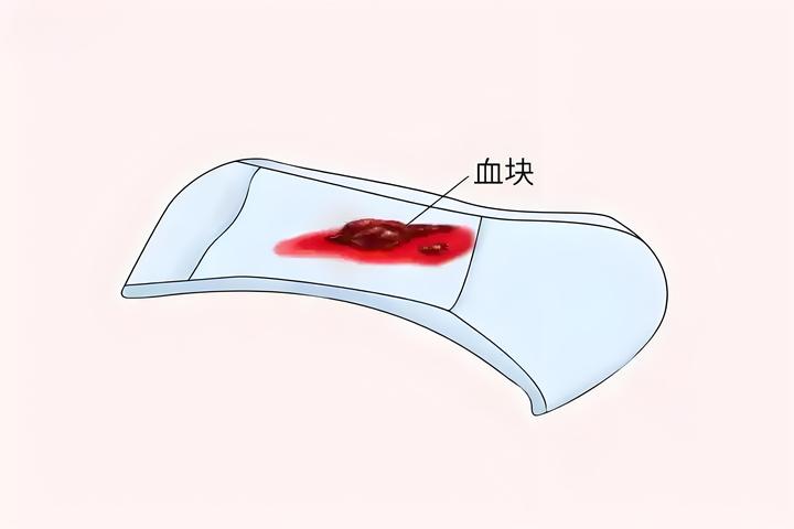 女生月经期掉出超大血块,千万警惕一种情况! - 知乎