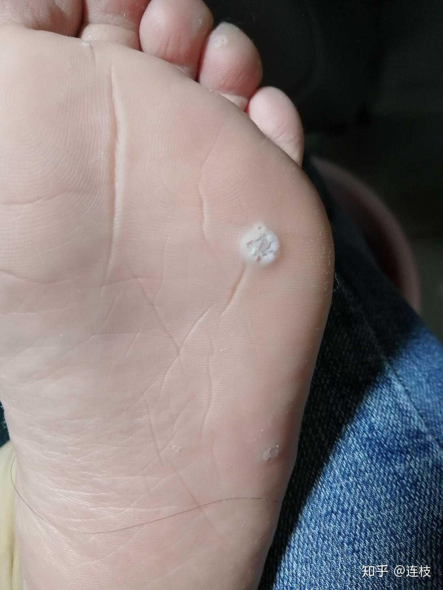 脚上感染长了疣,怎么弄. - 知乎
