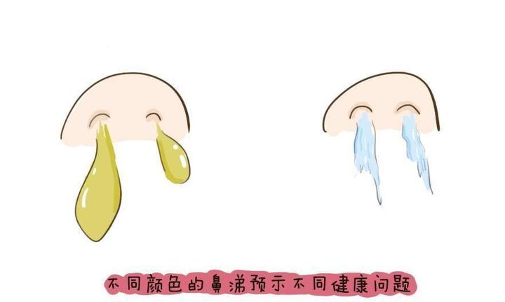 鼻涕不一样鼻炎的治法也不同