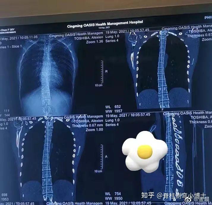 脊柱側彎30度可以當模特嗎