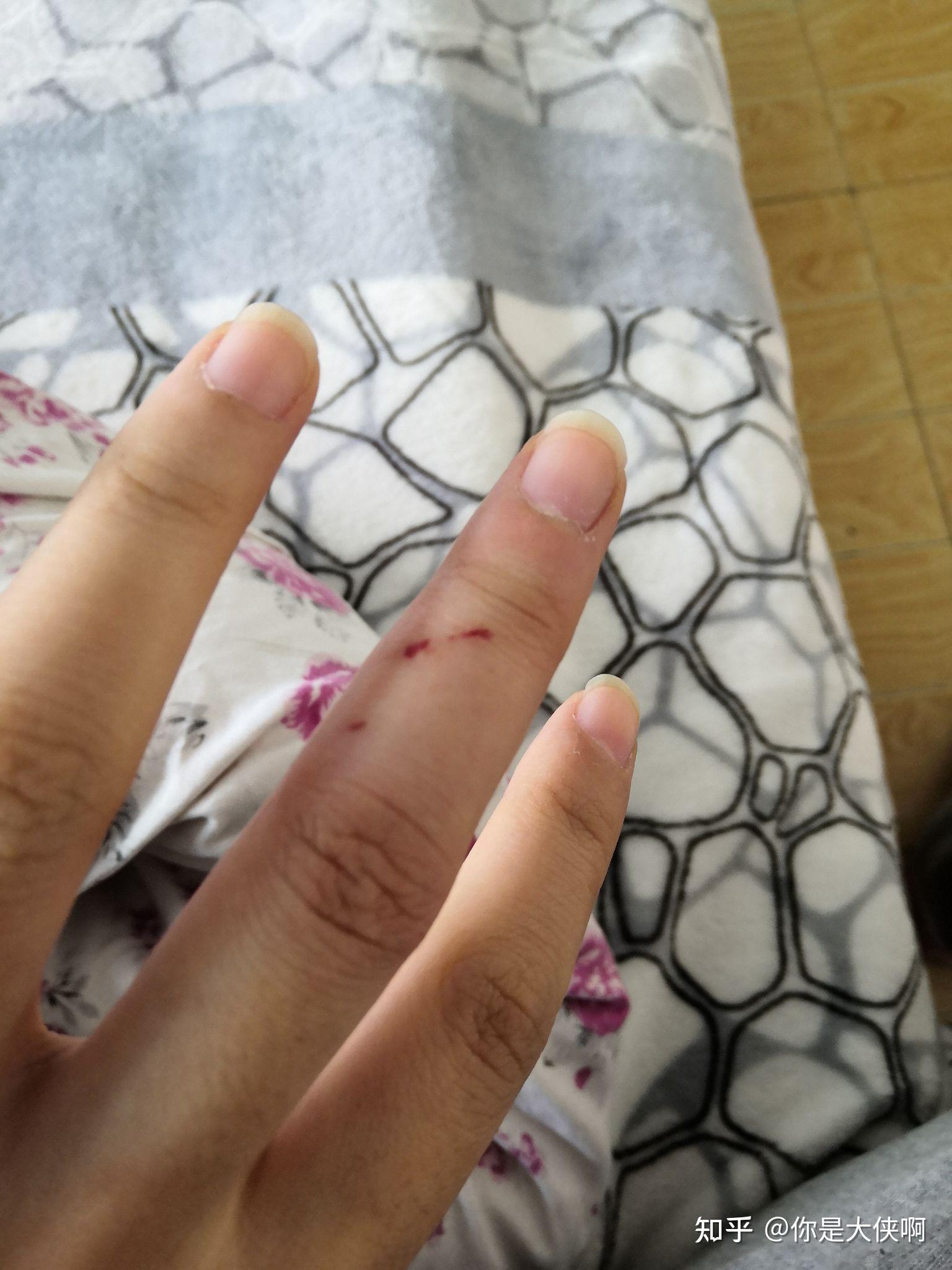 被猫咬出血（被猫咬出血了怎么办） 被猫咬出血（被猫咬出血了怎么办） 卜算大全